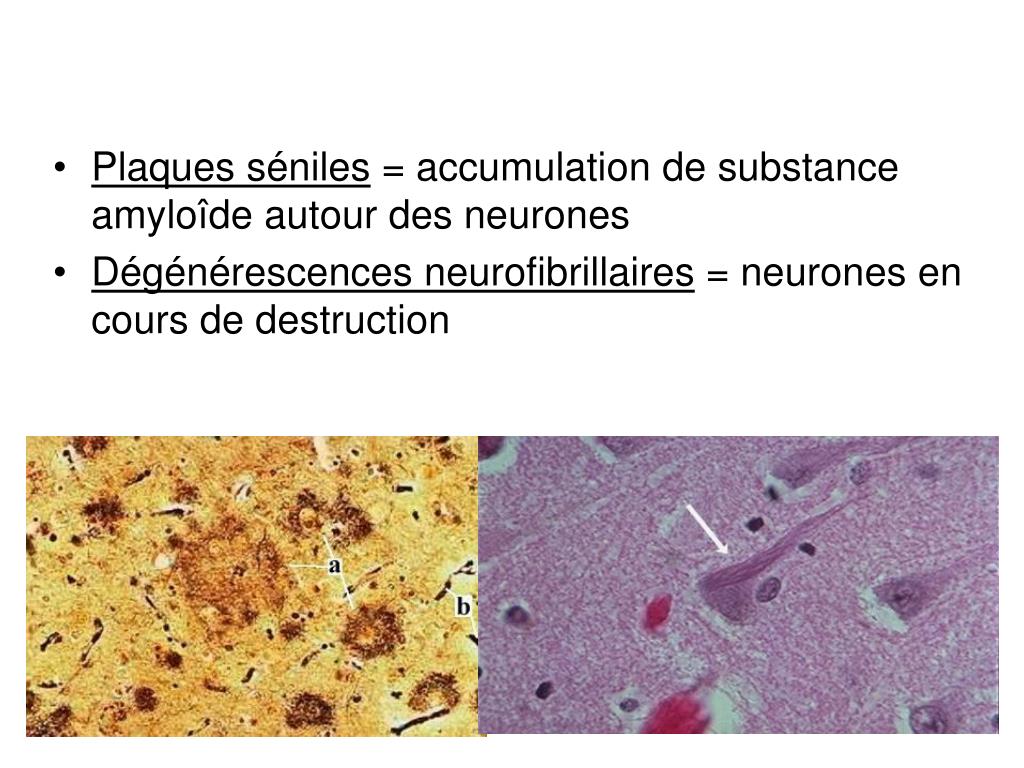 PPT - Maladie d’Alzheimer et autres démences PowerPoint Presentation ...