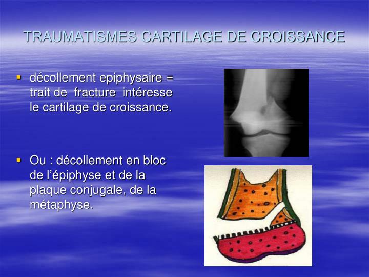 PPT TRAUMATISMES CARTILAGE CROISSANCE PowerPoint Presentation ID1070311