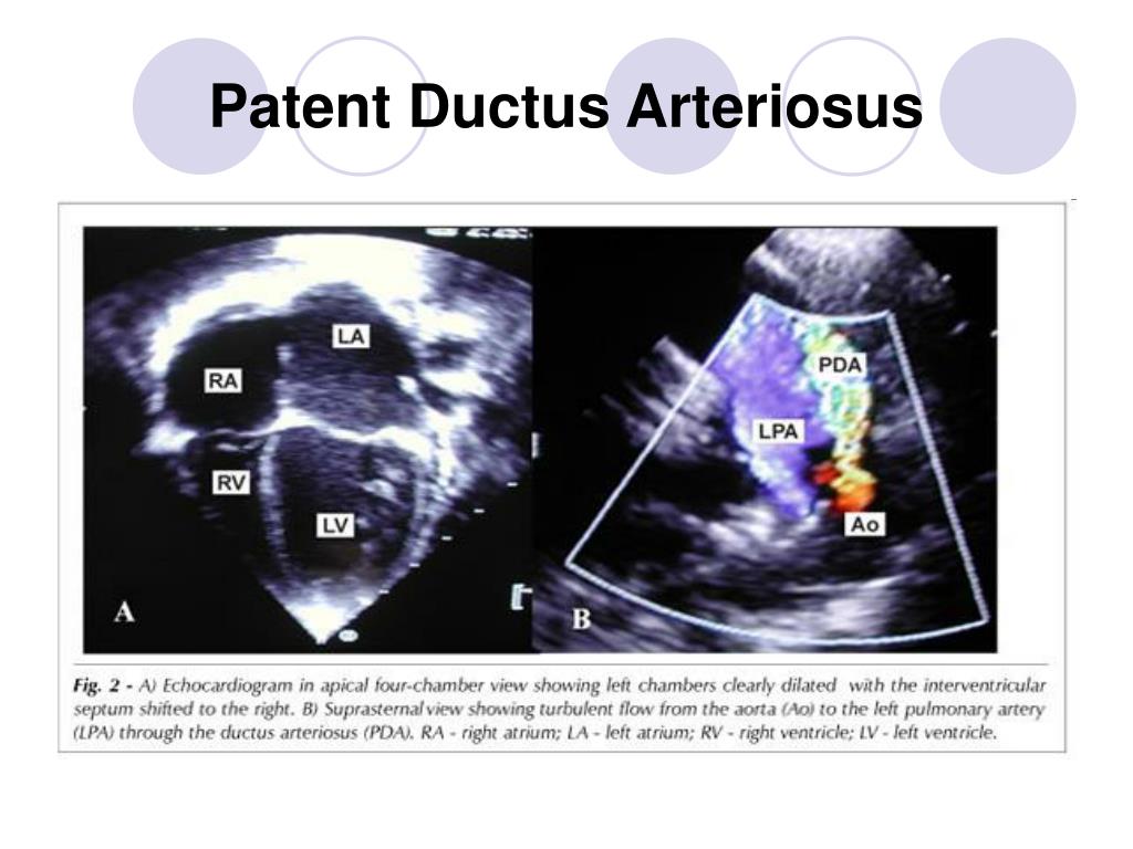 PPT - Patent Ductus Arteriosus PowerPoint Presentation, free download ...