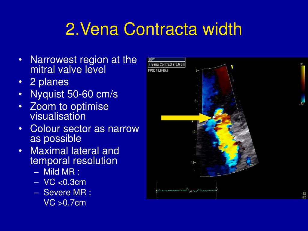 Ppt how to diagnose and assess severity of mitral regurgitation by