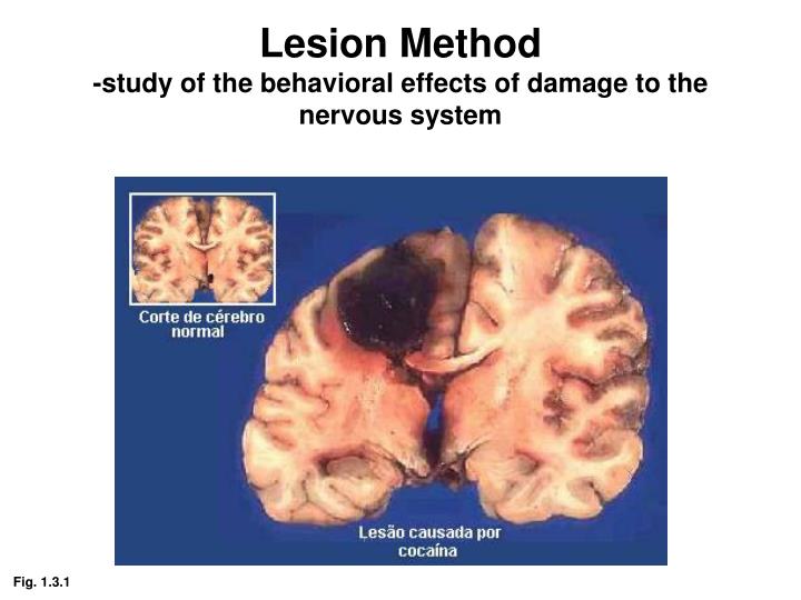 PPT - Phineas Gage Brain damage caused profound psychological changes. PowerPoint Presentation