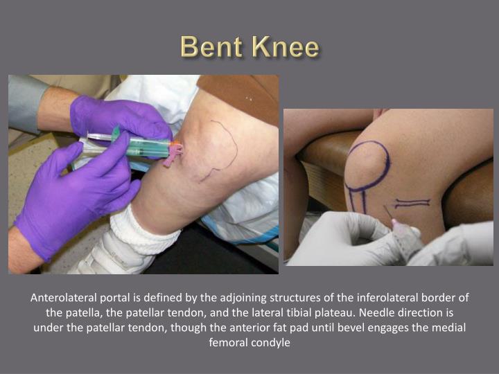 PPT - Arthrocentesis and Joint Injection for the Internist PowerPoint