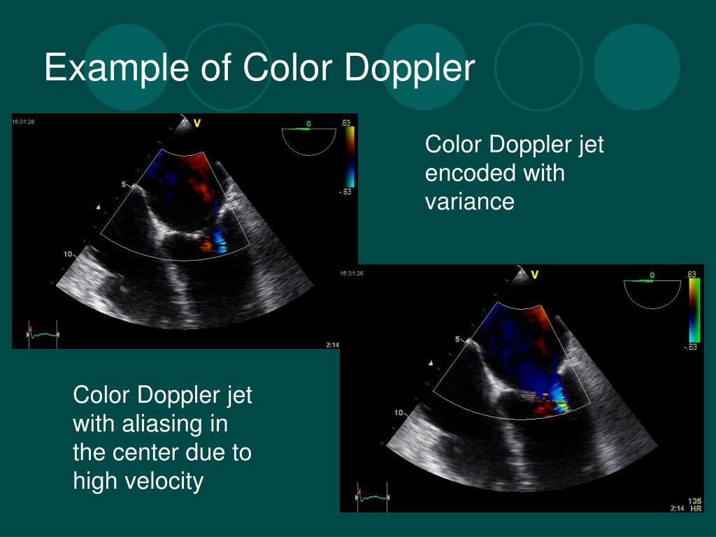 PPT Doppler Echocardiography PowerPoint Presentation, free download ID1113101