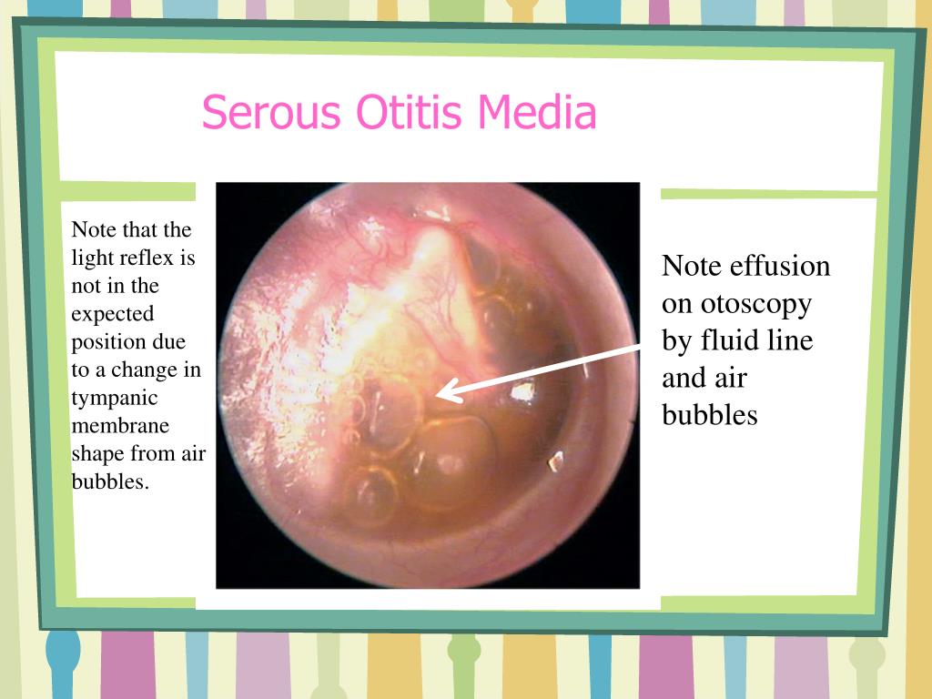 Acute otitis media is an infection and inflammation o - vrogue.co