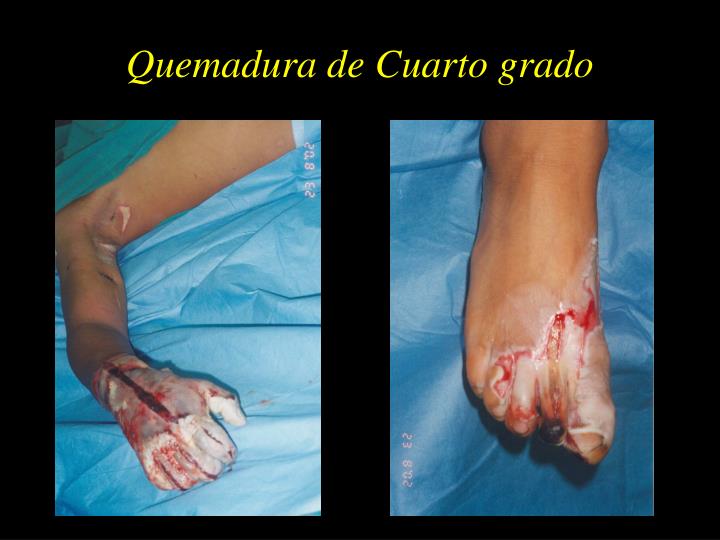 PPT - Rol del Pediatra en el Manejo Inicial del Niño Quemado ... PPT - Rol del Pediatra en el Manejo Inicial del Niño Quemado ...