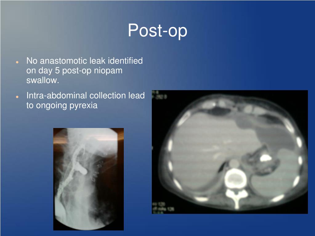 PPT Colonic interposition for benign oesophageal disease. PowerPoint