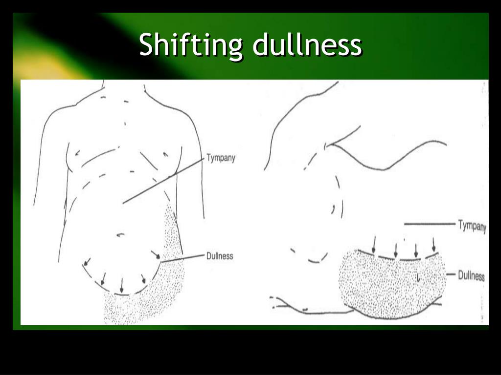 PPT Ascites And Abdominal Swelling PowerPoint Presentation Free 