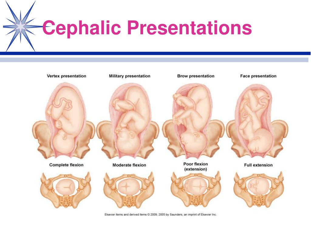 define cephalic presentation fetus