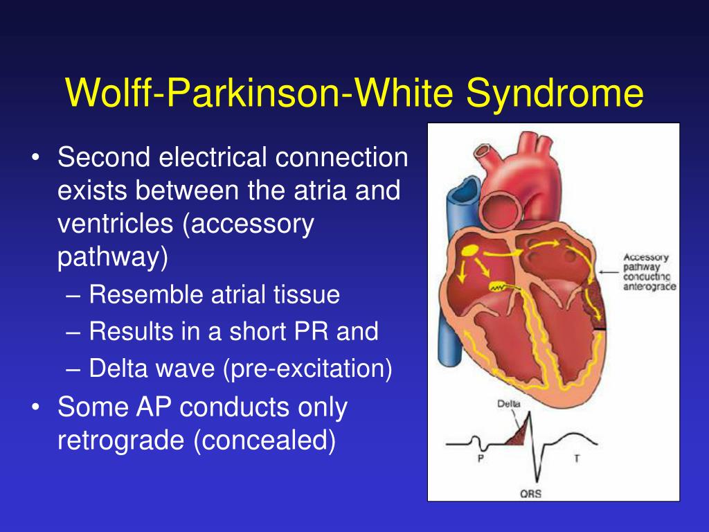PPT - Supraventricular Arrhythmias PowerPoint Presentation, free ...