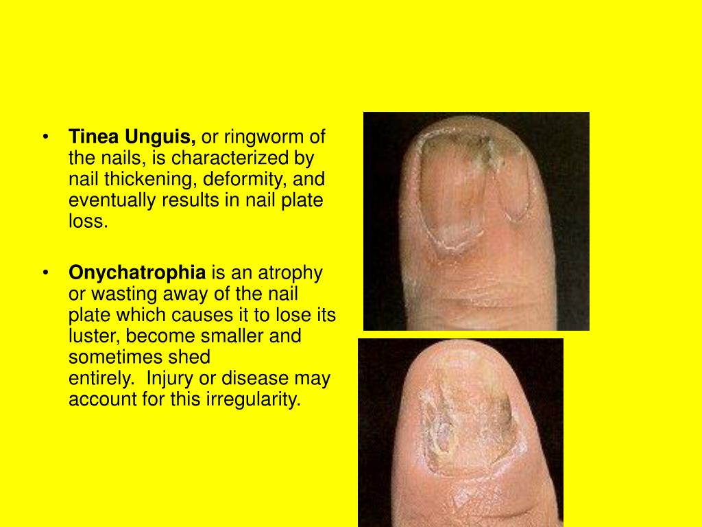 How deep should we actually open the nail pocket? Swipe 👉👉👉 1. We find  the point of growth. On the slide, we marked it in pink color. 2. From the  ingrowth point