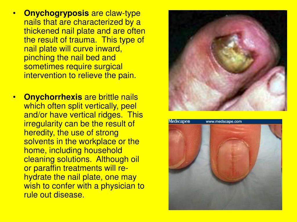 Nail-Patella Syndrome: Clinical Clues for Making the Diagnosis | MDedge  Dermatology