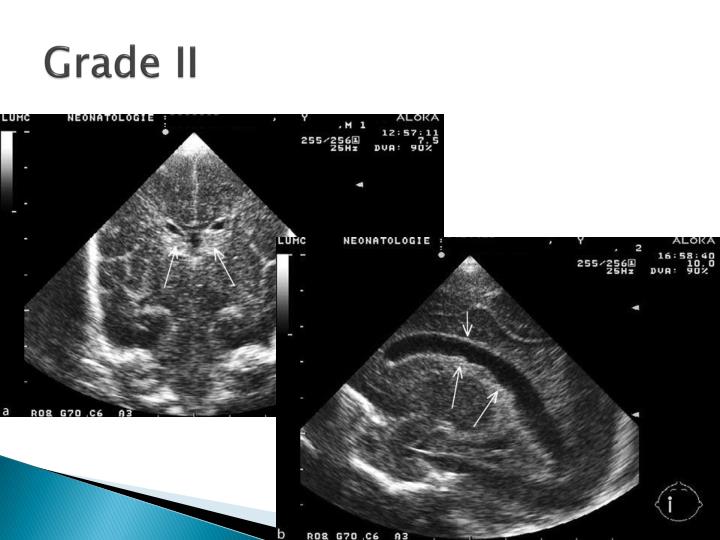 PPT - Neonatal Cranial Ultrasound (Part II) Classification ...
