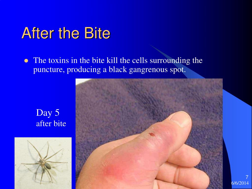 Brown Recluse Bite. - ppt video online download