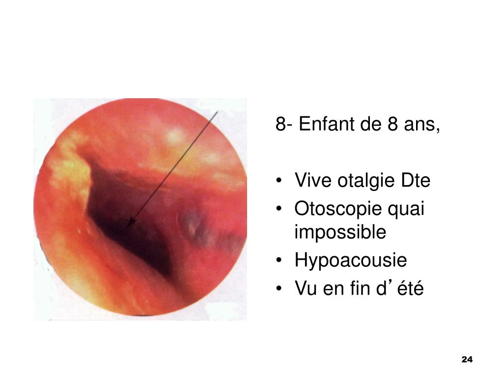 PPT - Des tympans ….. PowerPoint Presentation, free download - ID:1155281