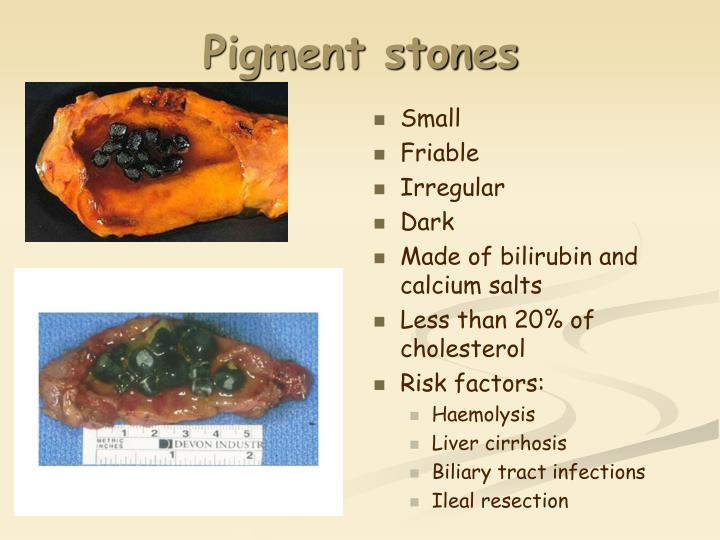 PPT - GALLSTONES PowerPoint Presentation - ID:1158373