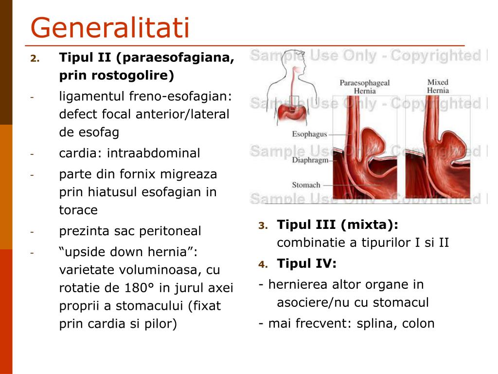 PPT - PATOLOGIA ESOFAGULUI (II) PowerPoint Presentation, free download -  ID:1161238