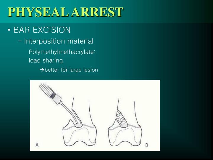 Bar Resection PPT - PHYSEAL INJURY PowerPoint Presentation - ID:1165011
