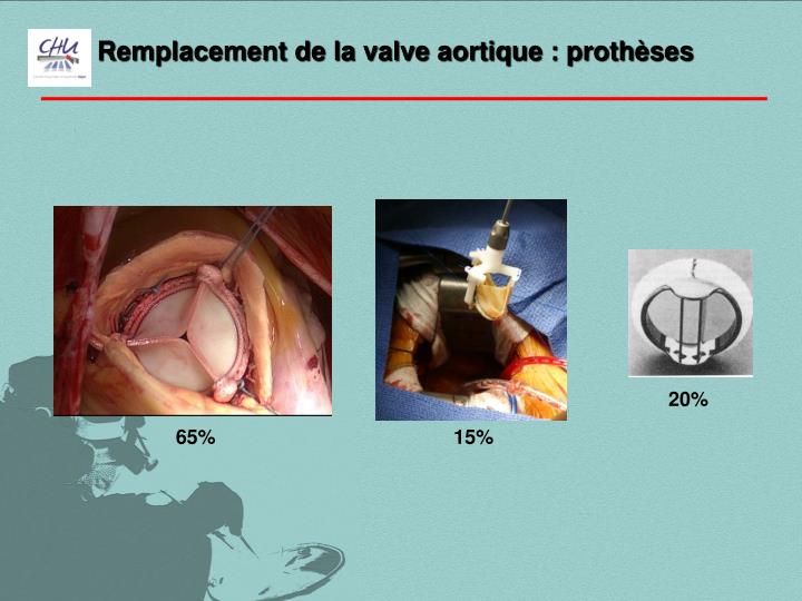 PPT Le remplacement de la valve aortique par mini thoracotomie droite PowerPoint Presentation