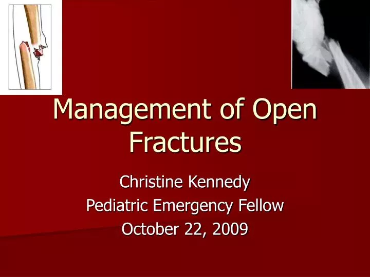 management of open fractures n.
