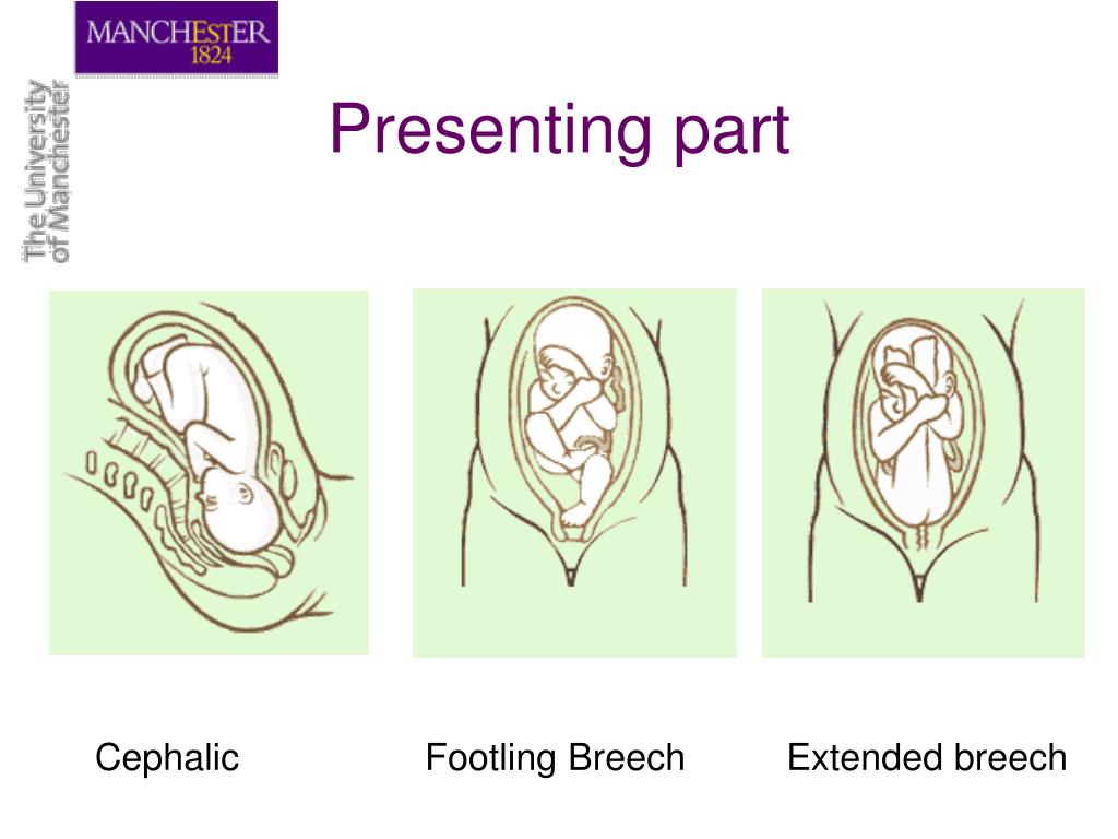 in a cephalic presentation the presenting part is usually the