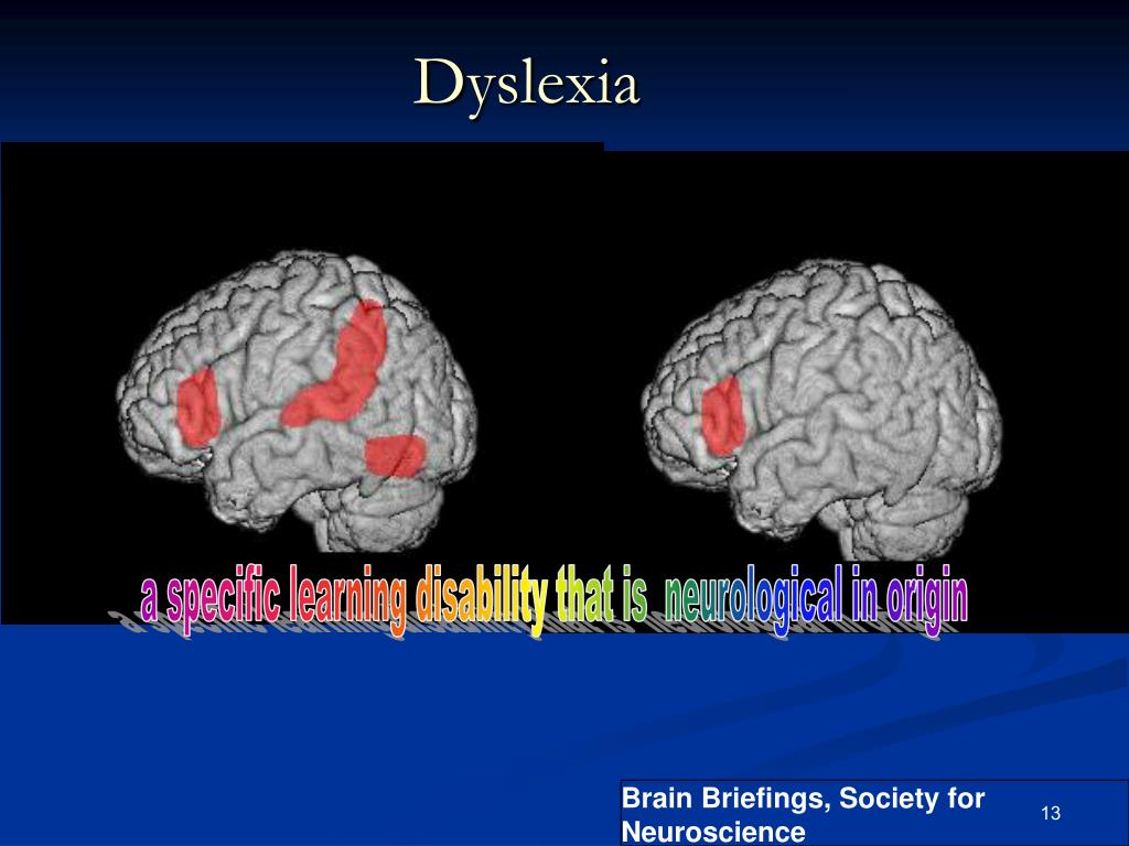 Dyslexi A Specific Neurological Learning Disability