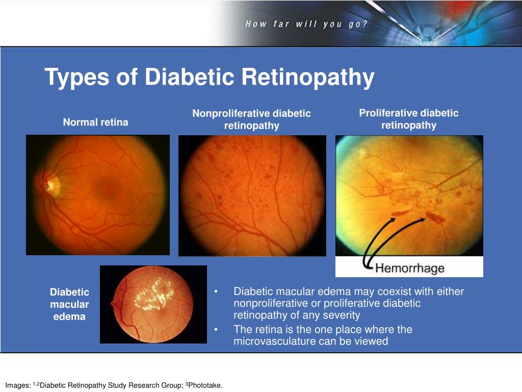 PPT - How Far Would You Go To Address Diabetic ...