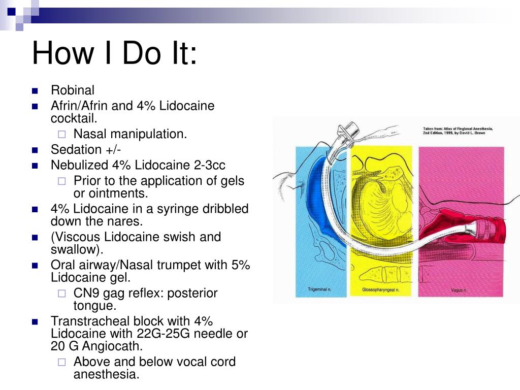 lidocaine swish and swallow lidocaine swish and swallow