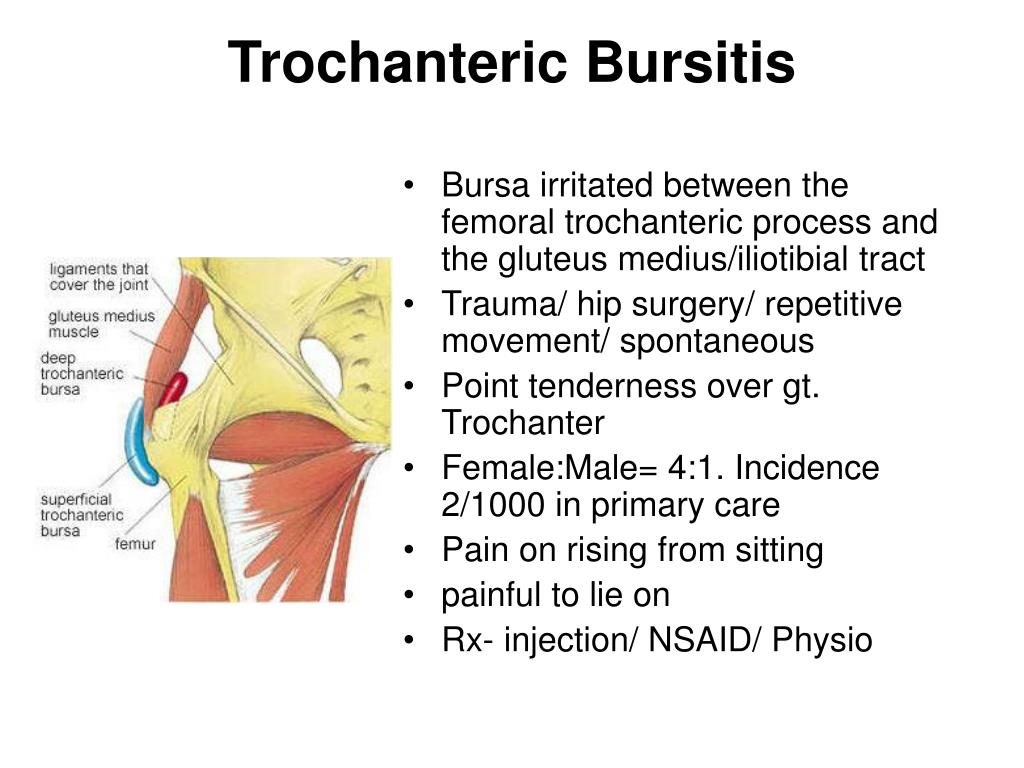 Ppt Trochanteric Bursitis Powerpoint Presentation Free Download Id