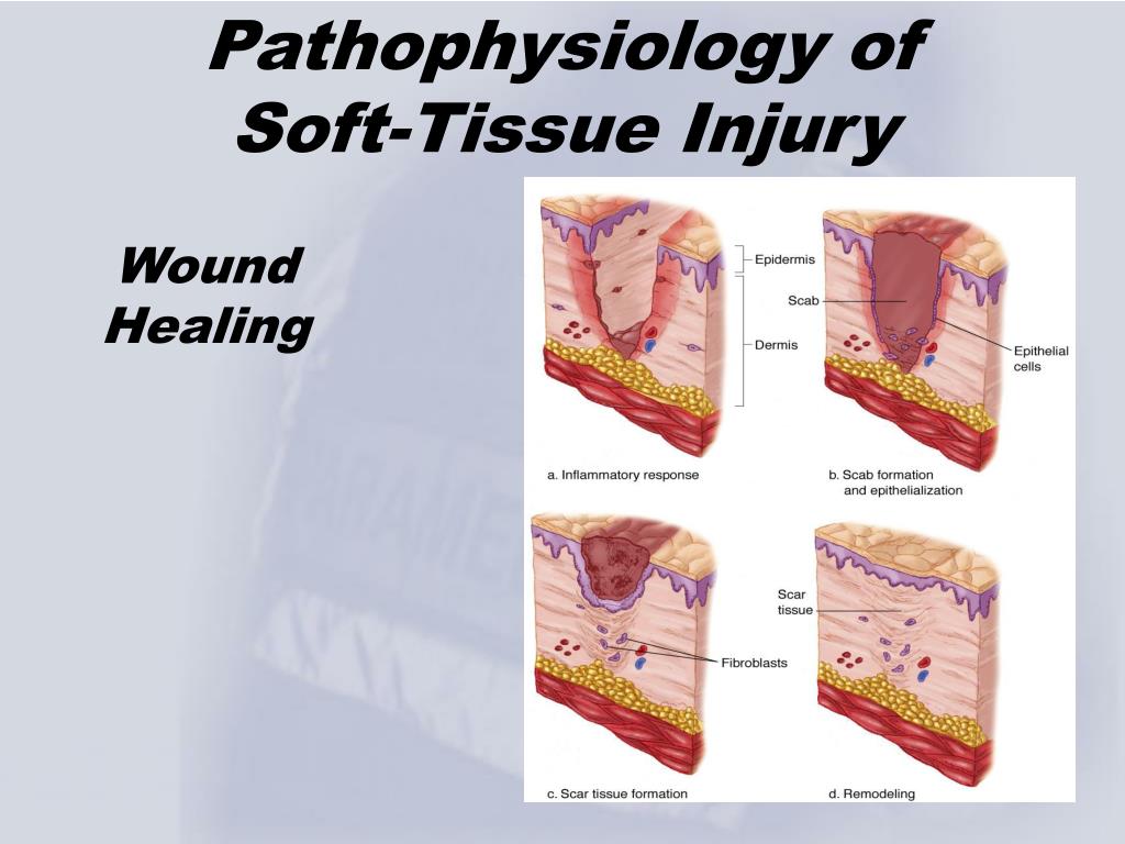 Ppt Chapter 5 Soft Tissue Trauma Powerpoint Presentation Free Download Id 1214059