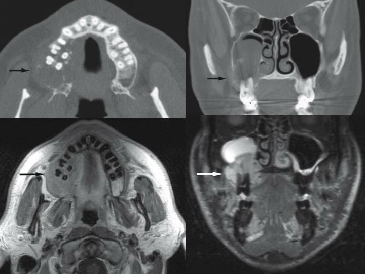 PPT Malignant Jaw tumors PowerPoint Presentation ID1214068
