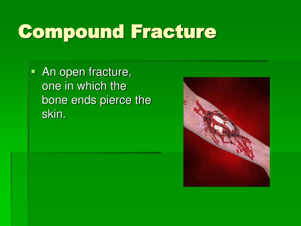 define compound fracture define compound fracture
