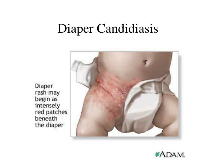 PPT - Dermatological disorders in children PowerPoint Presentation - ID ...
