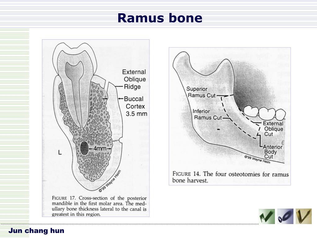 PPT VERTICAL RIDGE AUGMENTATION PowerPoint Presentation Free 