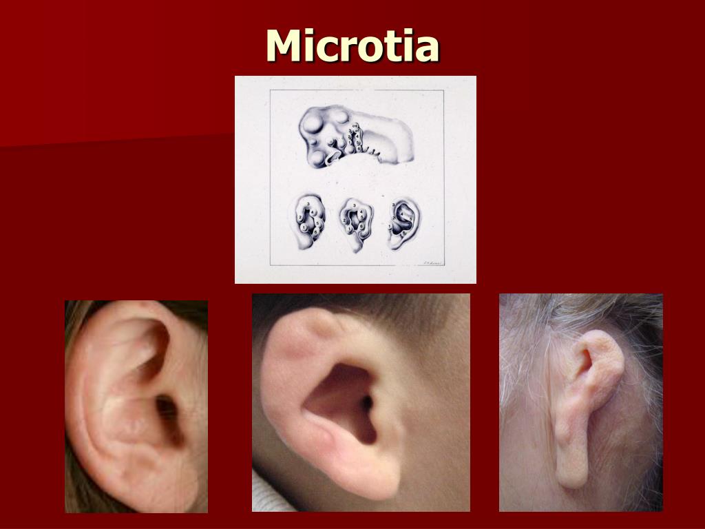 congenital aural atresia congenital aural atresia