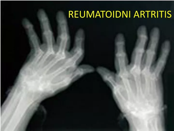 reumatoidni artritis n.