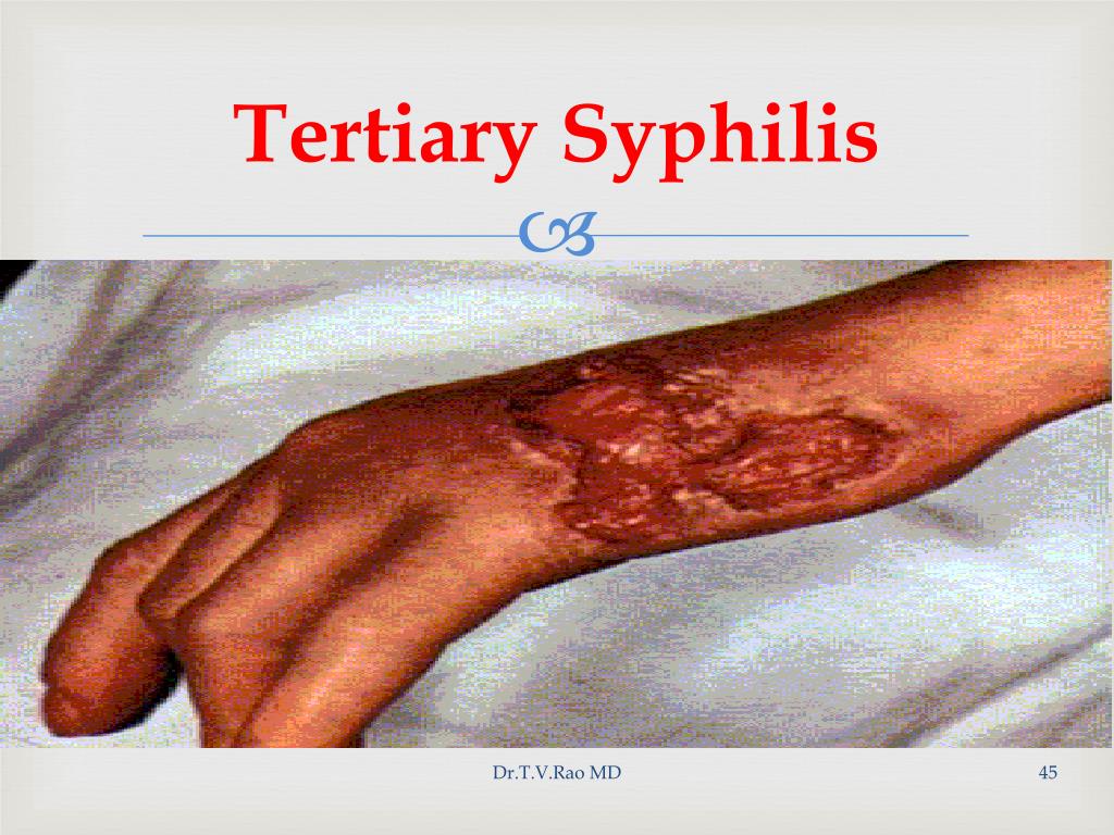 presentation of tertiary syphilis