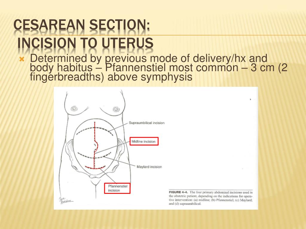 transverse presentation cesarean section