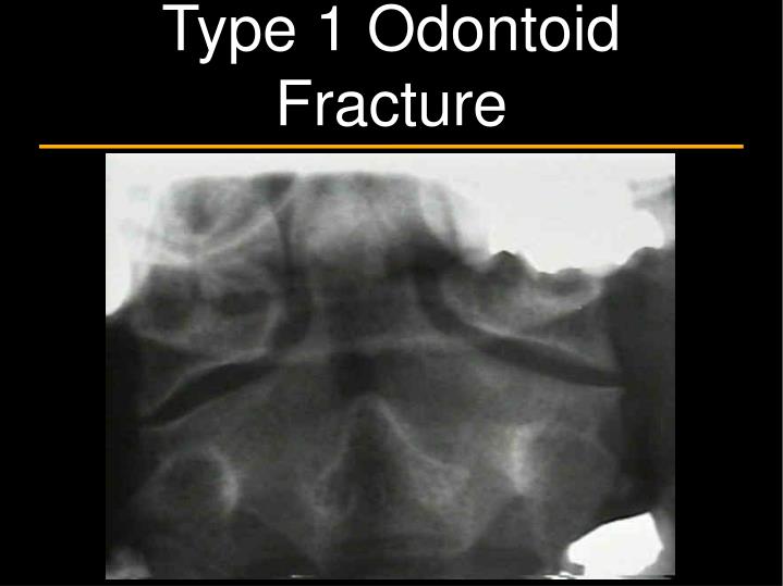 odontoid fracture type 1 odontoid fracture type 1