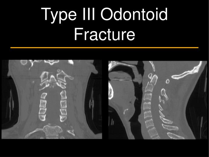 icd 10 odontoid fracture icd 10 odontoid fracture