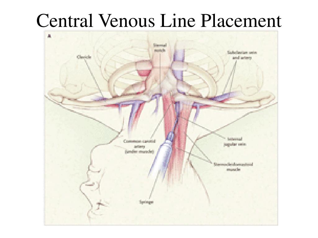 Левая подключичная вена. Внутренняя яремная Вена пункция. Внутренняя яремная Вена катетеризация. Наружная и внутренняя яремная Вена анатомия. ЦВК внутренней яремной вены.