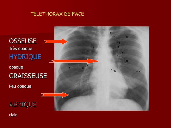 Silhouette Cardio Médiastinale Dans Les Limites De La Normale