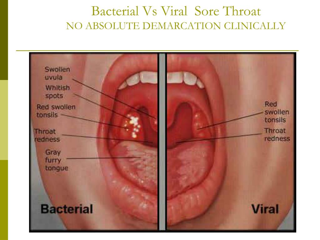 Bacterial Vs Viral Sore ThroatNO ABSOLUTE DEMARCATION 