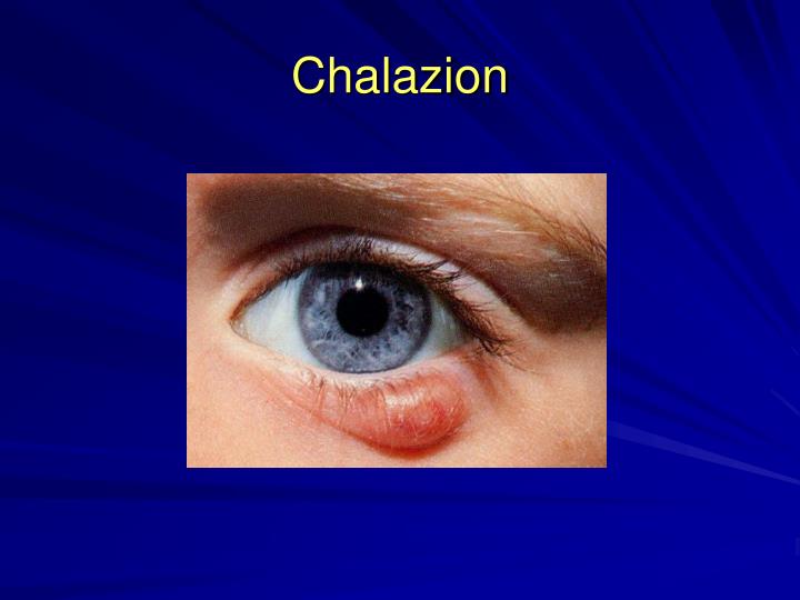 PPT - Ocular Emergencies PowerPoint Presentation - ID:1259257