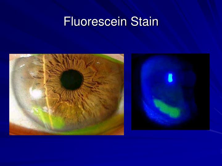 PPT Ocular Emergencies PowerPoint Presentation ID1259257