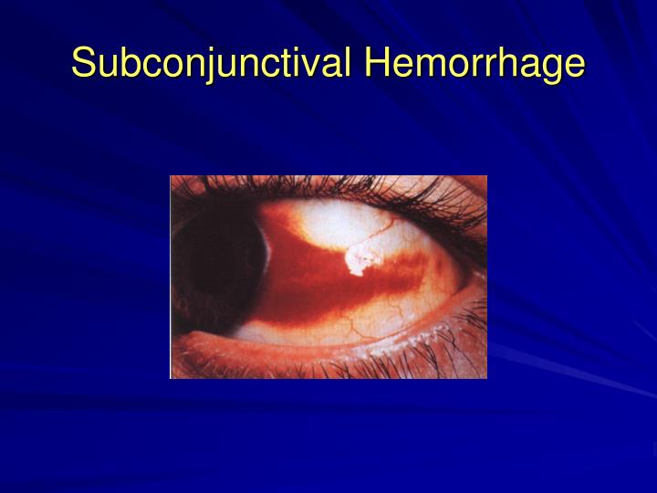 PPT Ocular Emergencies PowerPoint Presentation ID1259257