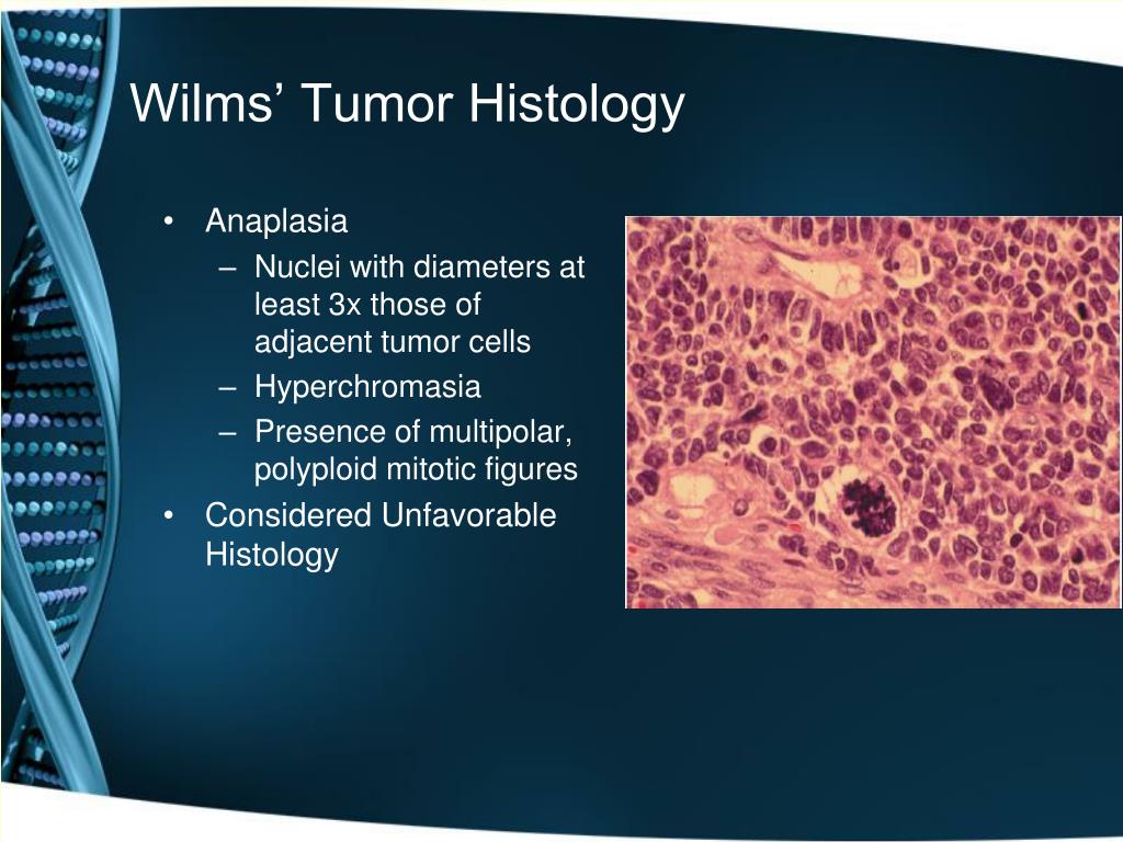 wilms tumor histology1.