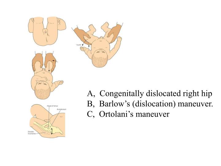Manœuvre d'ortolani et barlow