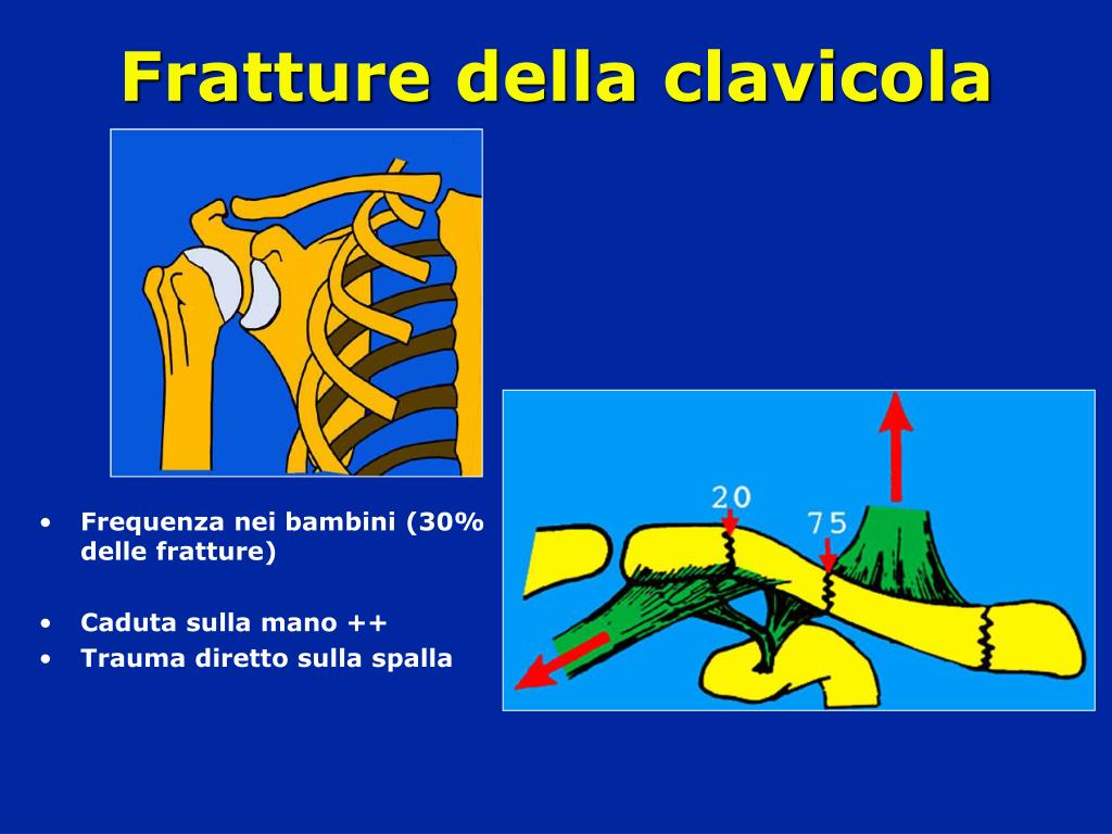 PPT Fratture della clavicola PowerPoint Presentation, free download