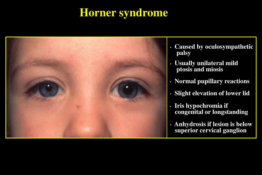 PPT - CLASSIFICATION OF PTOSIS PowerPoint Presentation, free download