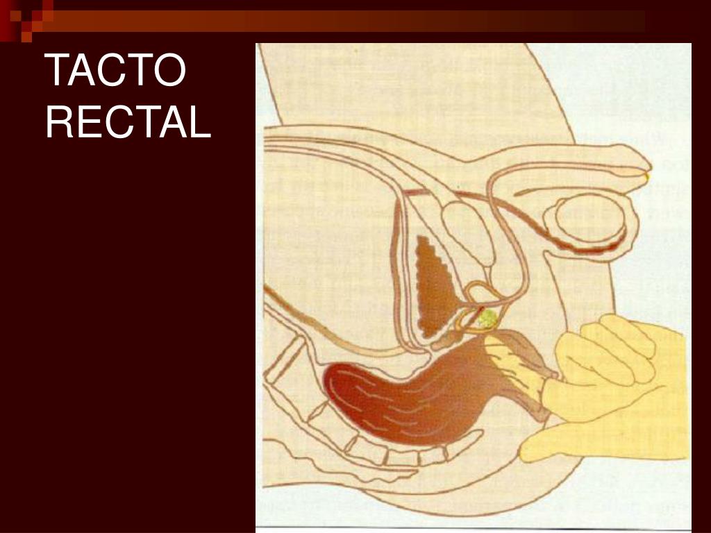 Despues de operacion de prostata se puede tener relaciones sexuales